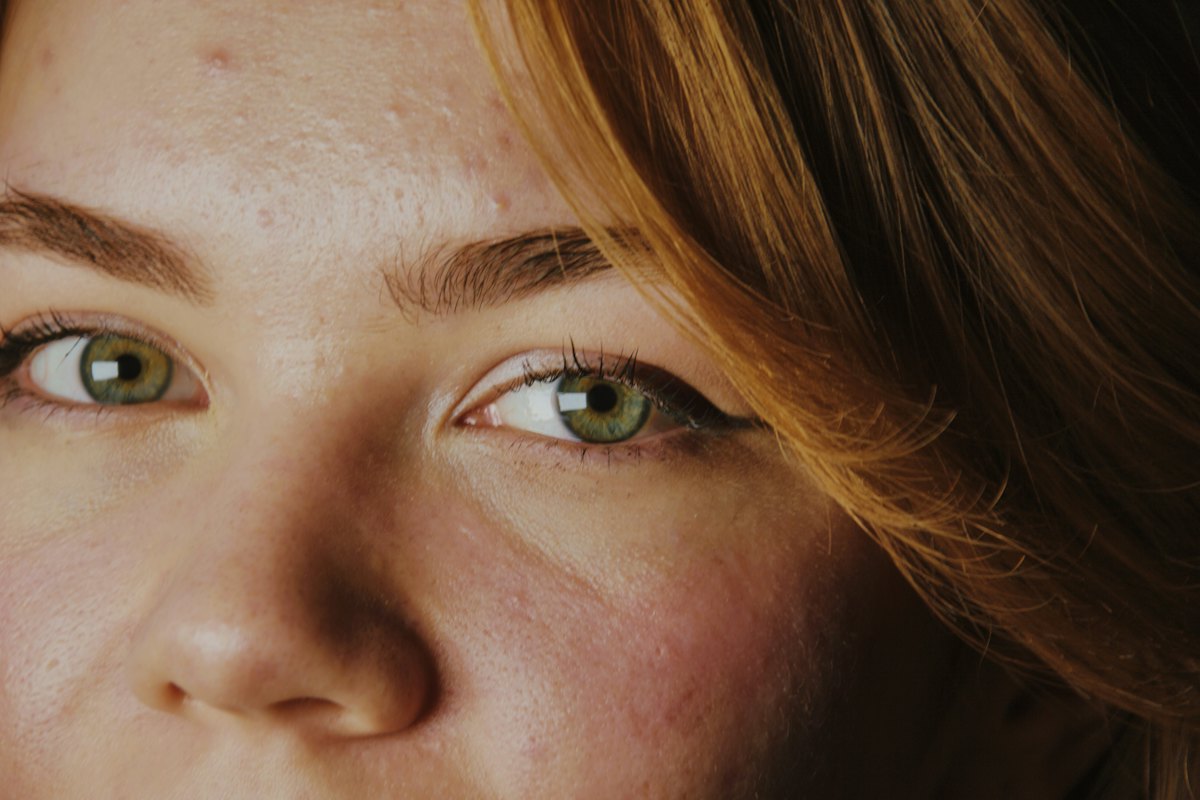 Mesotherapy skin boosters for clients from Crossgar